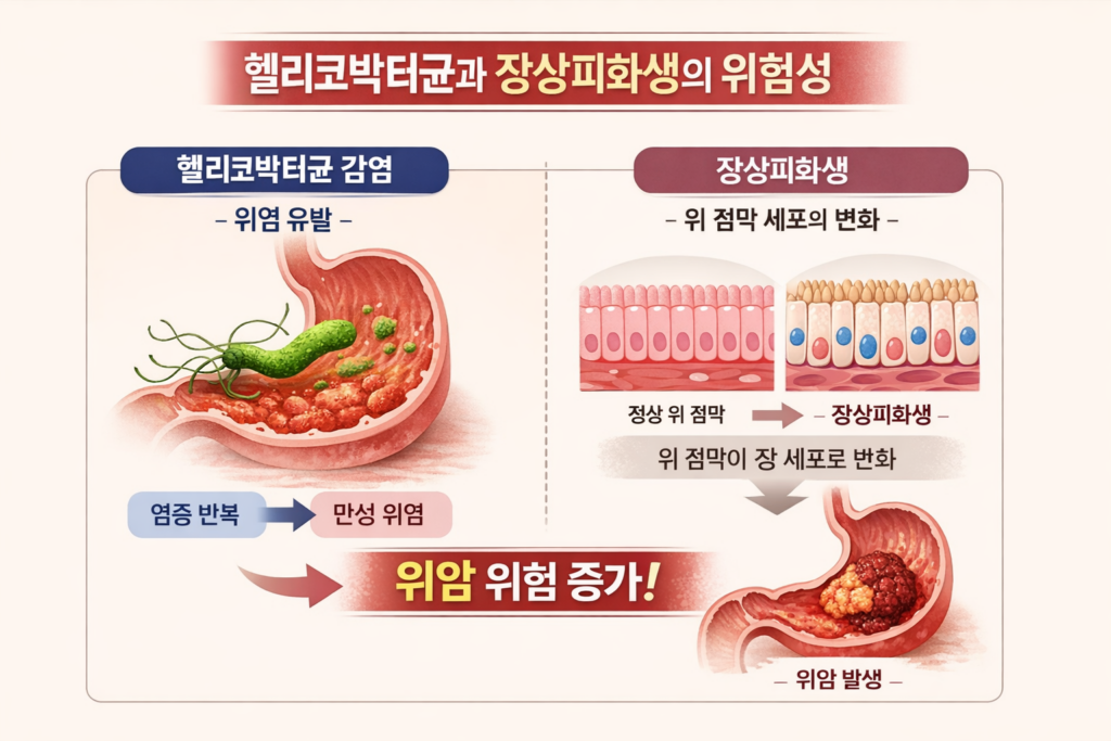 헬리코박터균 감염으로 위 점막에 염증이 반복되면서 만성 위염이 발생하고, 그 과정에서 위 점막 세포가 장 세포 형태로 변화해 장상피화생으로 진행되며 위암 위험이 증가하는 과정을 설명한 인포그래픽
